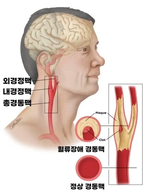 내경정맥위치